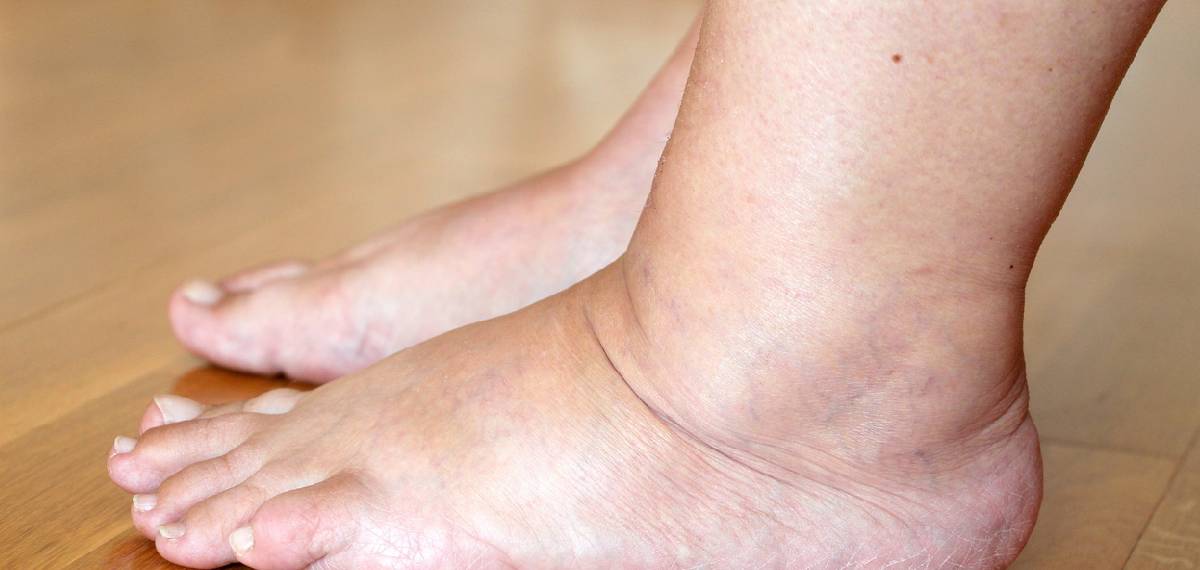 വൈകുന്നേരമാകുമ്പോള്‍ കണങ്കാലുകളിലും കാല്‍പത്തിയിലും നീര് ഉണ്ടാകാറുണ്ടോ?