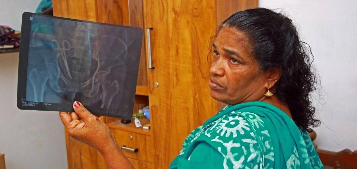 ഉഷ ജോസഫിന്‍റെ ശസ്ത്രക്രിയ പൂർത്തിയായി; വയറ്റിൽ കുടുങ്ങിയിരുന്ന കത്രിക പുറത്തെടുത്തു