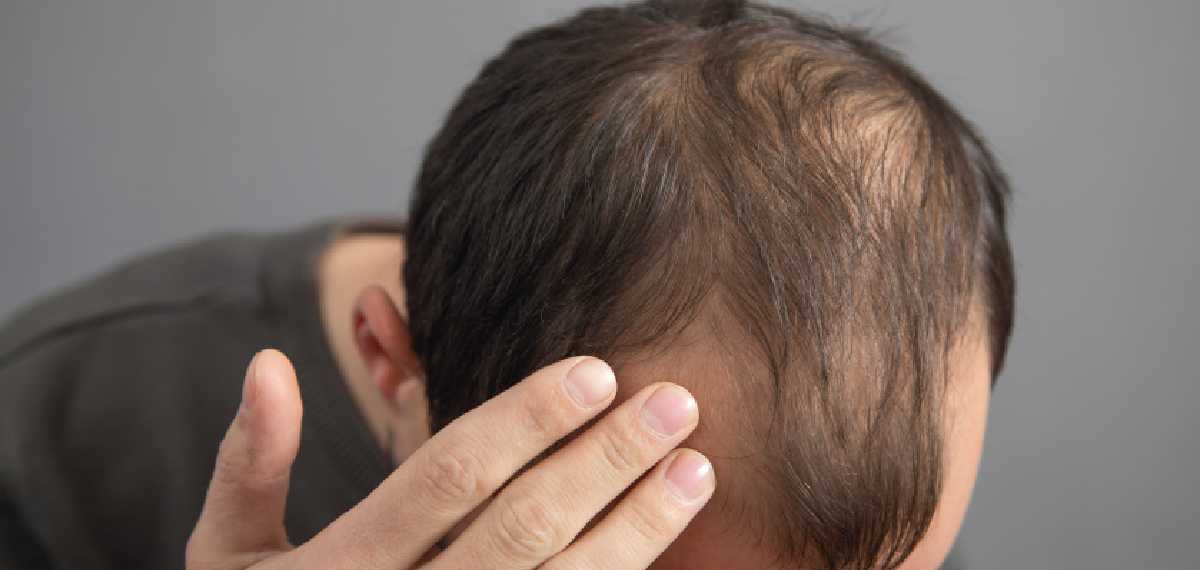 baldness and smoking