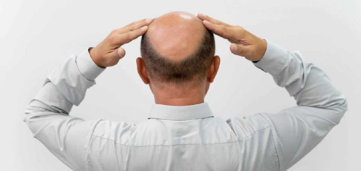 പുരുഷന്മാരില് കഷണ്ടി വരാനുള്ള കാരണം ഈ ദുശ്ശീലം. പഠനം പറയുന്നത് ഇങ്ങനെ