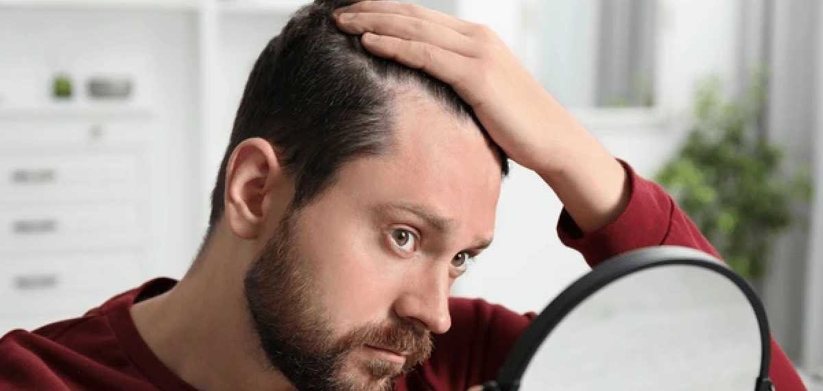 baldness and smoking