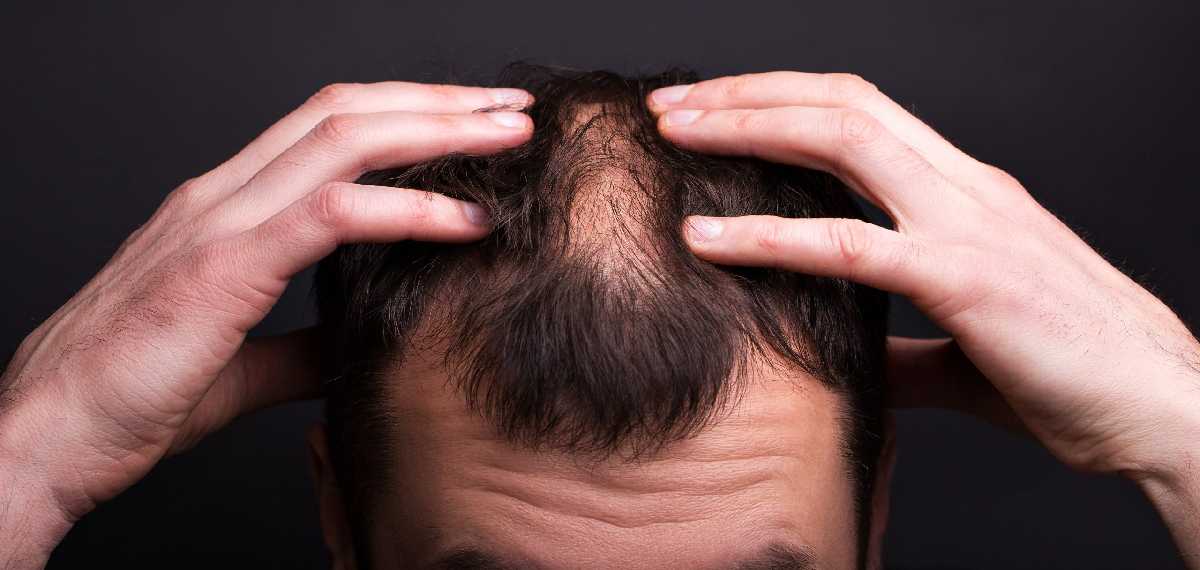 baldness and smoking