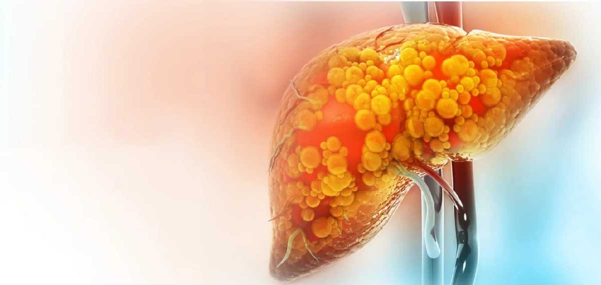fatty liver in IT JOBS