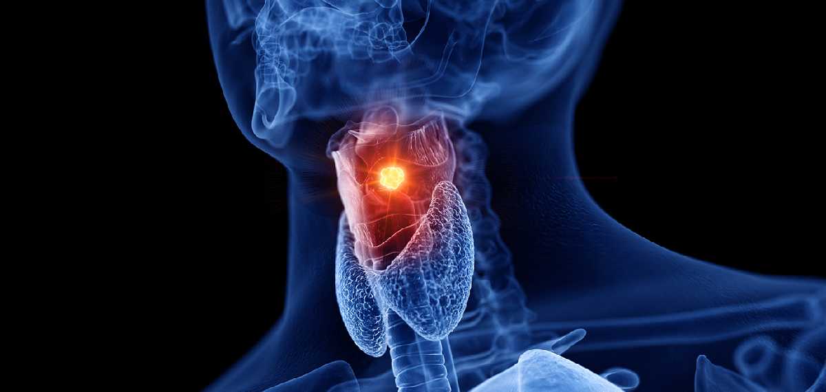 throat cancer
