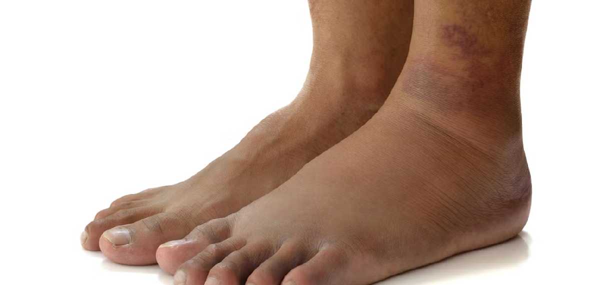 leg cramps and swelling at night