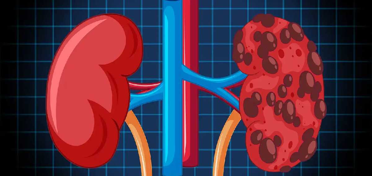 kidney disease
