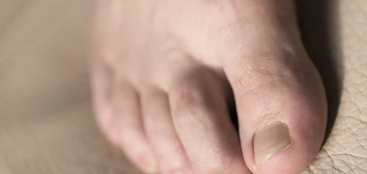hair loss on toes a sign of diabetes