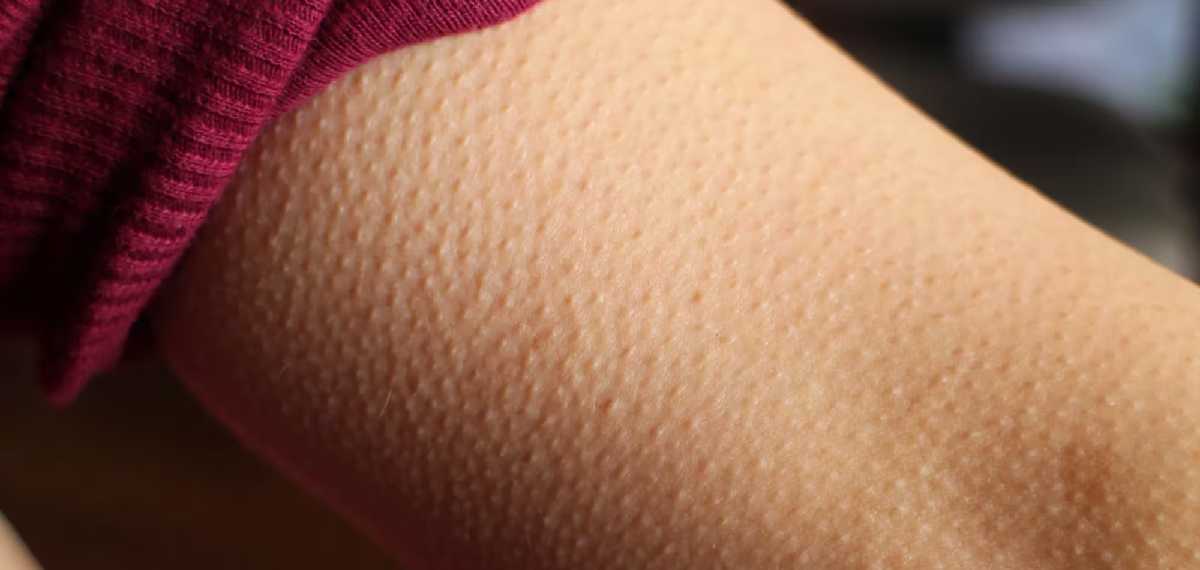goosebumps skin
