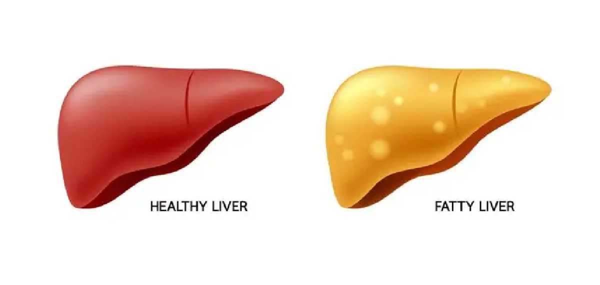 lean fatty liver