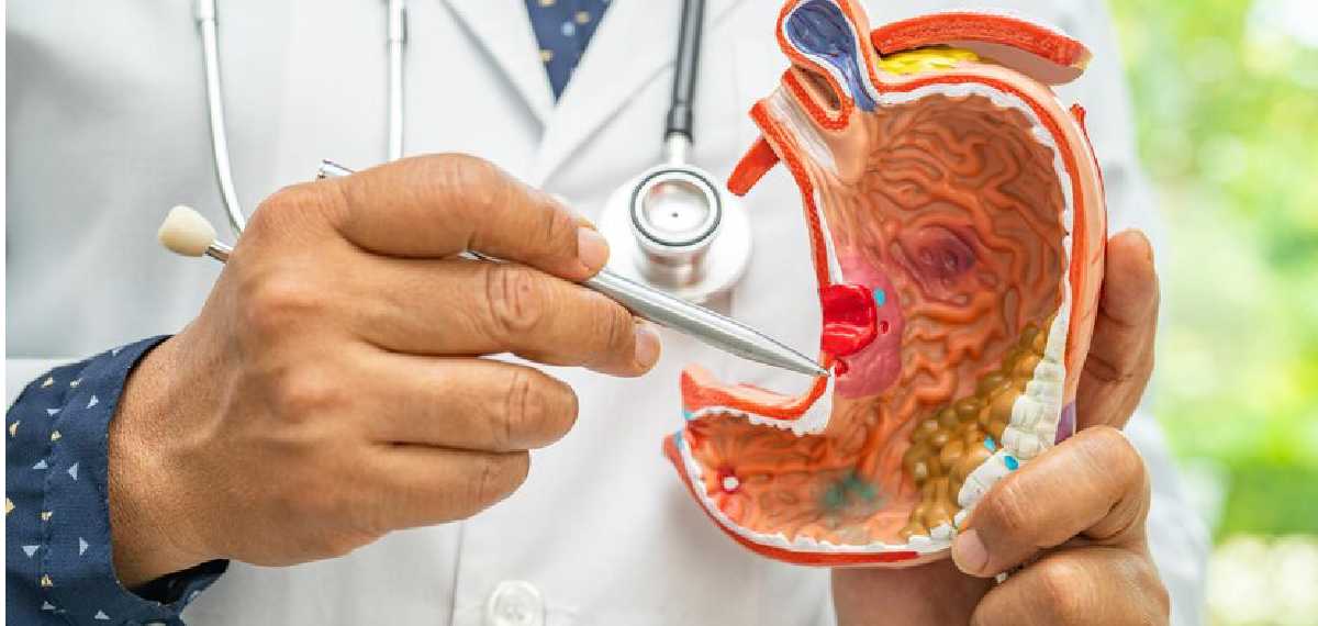 GASTROINTESTINAL CANCER