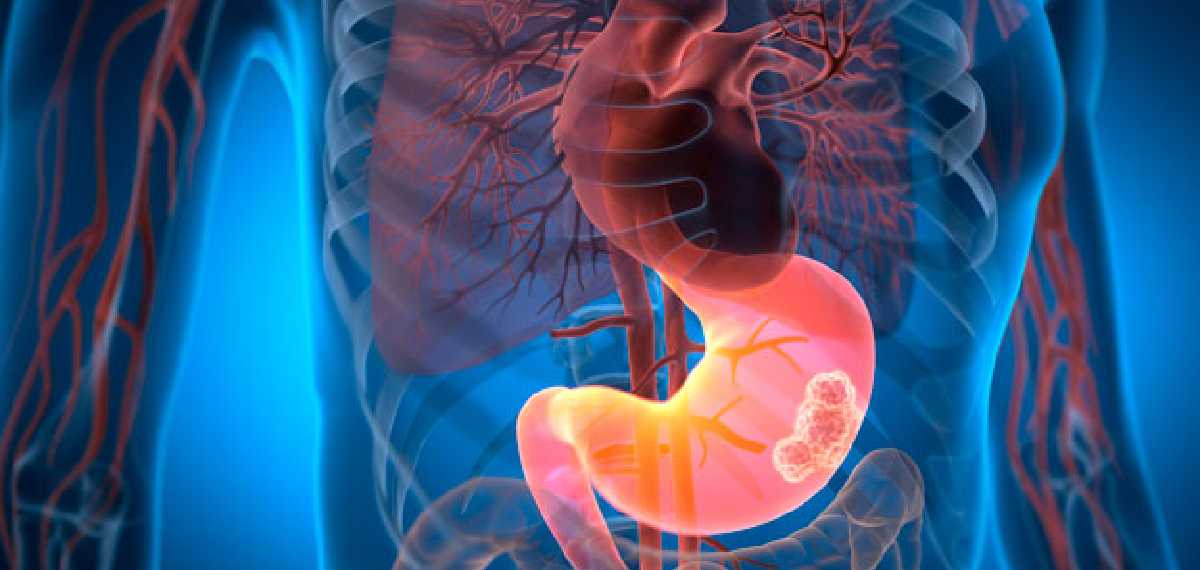 GASTROINTESTINAL CANCER
