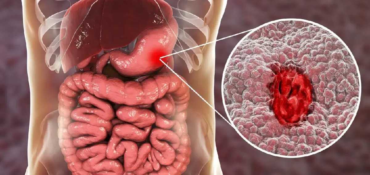 GASTROINTESTINAL CANCER