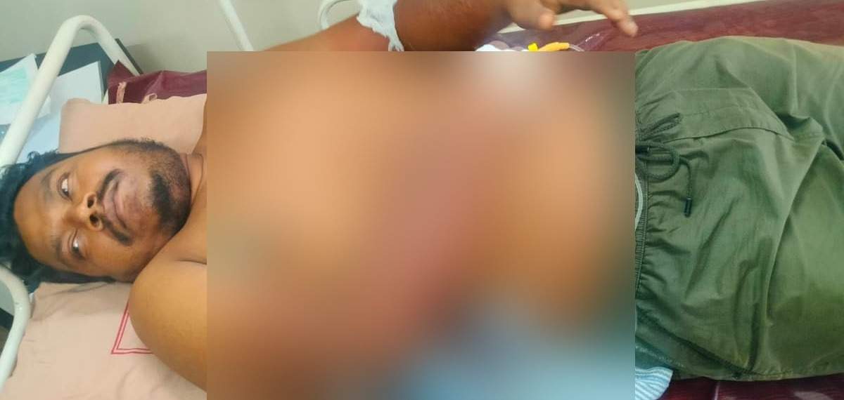 കൂത്താട്ടുകുളത്ത് സൂര്യാഘാതമേറ്റ് അതിഥി തൊഴിലാളിക്ക് ഗുരുതര പൊള്ളൽ