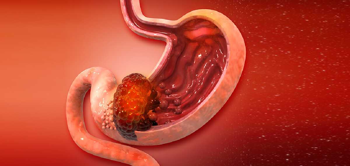 stomach cancer