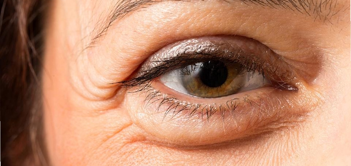 puffy eyes and kidney