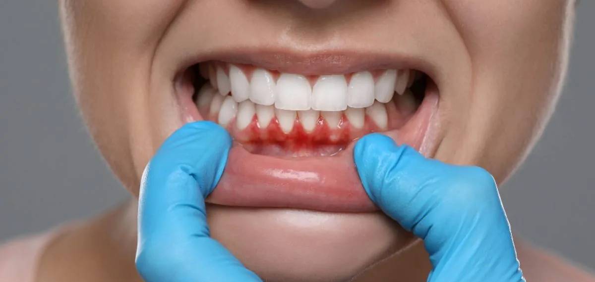 ORAL HEALTH AND HEART ATTACK
