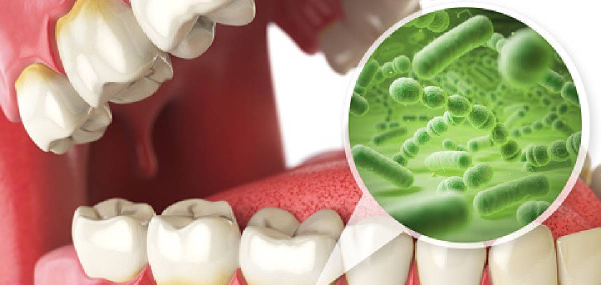 ORAL HEALTH AND HEART ATTACK