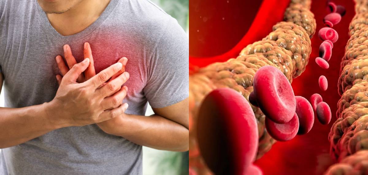 നിങ്ങള്‍ക്ക് കൊളസ്‌ട്രോള്‍ ഉണ്ടോ? അറിയാം ചില ലക്ഷണങ്ങളിലൂടെ