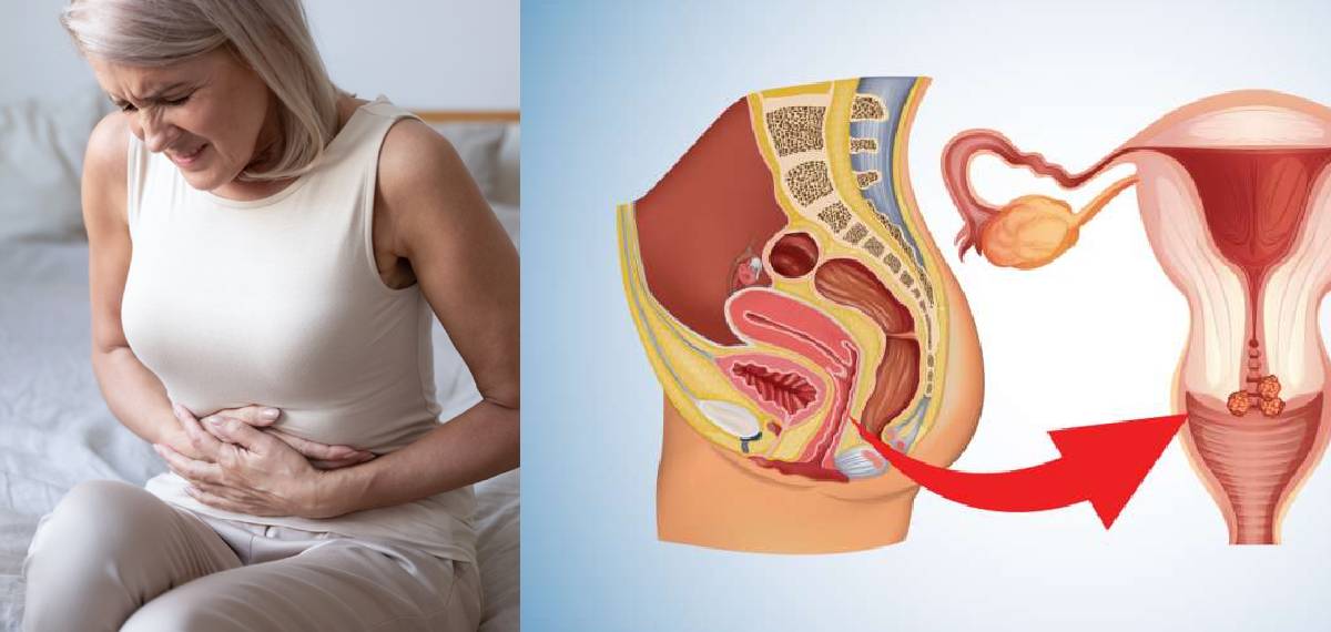 cervical cancer