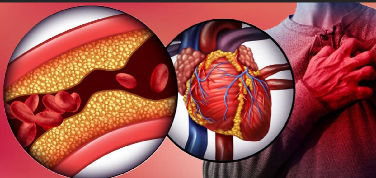 coronary artery disease