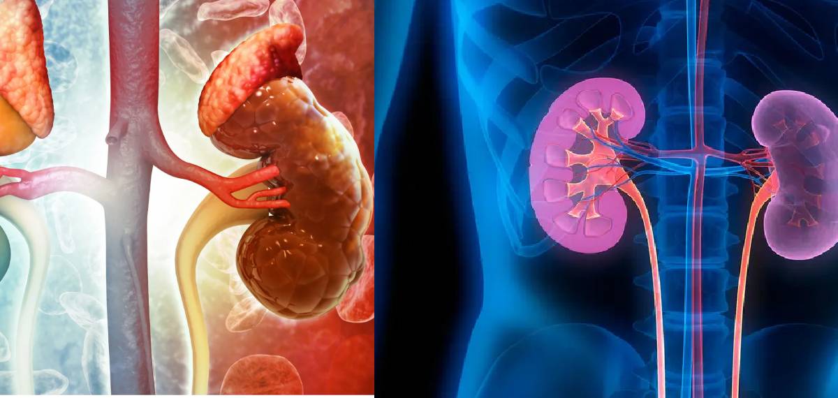 chronic kidney diseaset