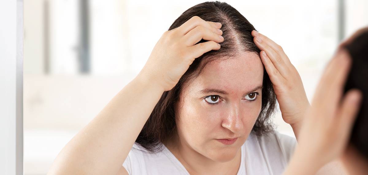 balding symptoms