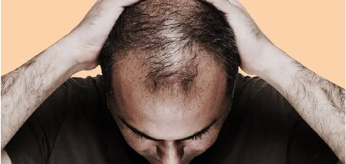ഭാവിയില് കഷണ്ടി വരാന് ചാന്സ് ഉണ്ടോ?; കഷണ്ടി വരും മുന്പ് ശരീരം നല്കുന്ന സൂചനകള്