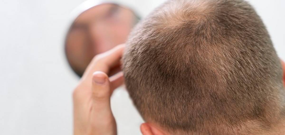 balding symptoms
