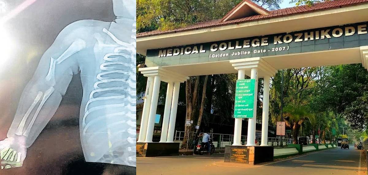 നവജാതശിശുവിന്‍റെ കയ്യൊടിഞ്ഞ സംഭവം;വേദനകൊണ്ട് പുളഞ്ഞിട്ടും ഡോക്ടർമാർ നോക്കിയില്ല,ആരോഗ്യമന്ത്രിയെ കാണാൻകുടുംബം