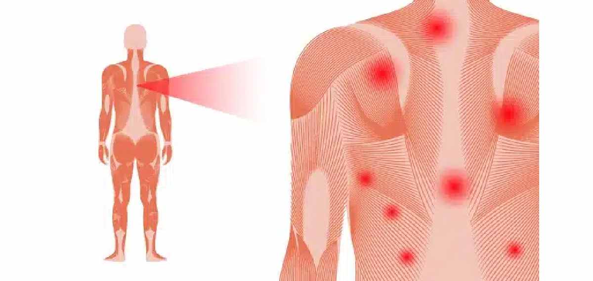 fibromyalgia
