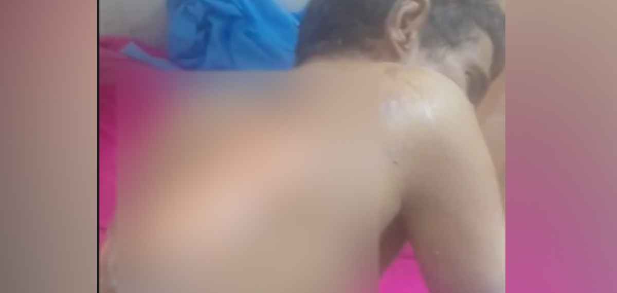കാസര്‍കോട് അതിഥി തൊഴിലാളിയെ തീ കൊളുത്തി കൊലപ്പെടുത്താന്‍ ശ്രമം