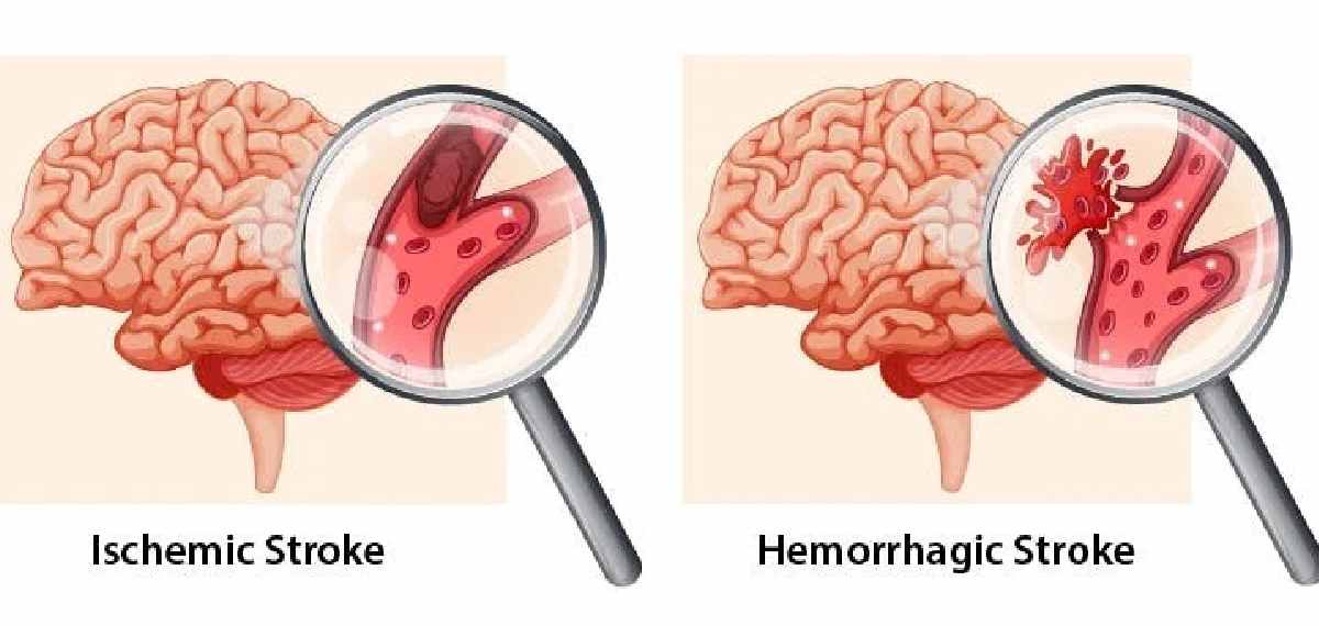 early signs of a stroke