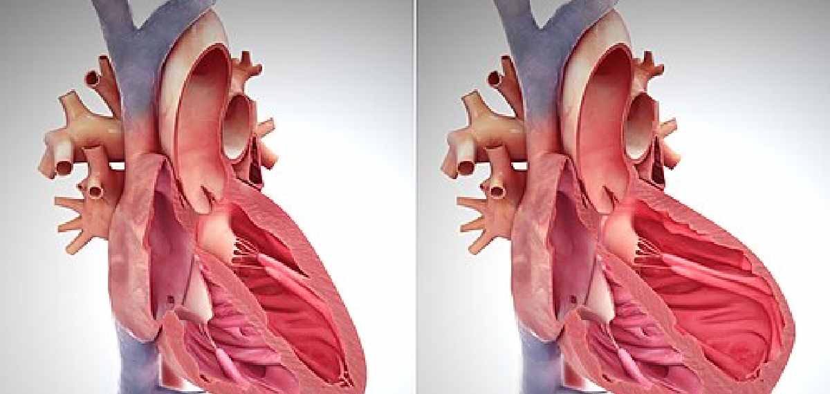 heart attack and cardiac arrest