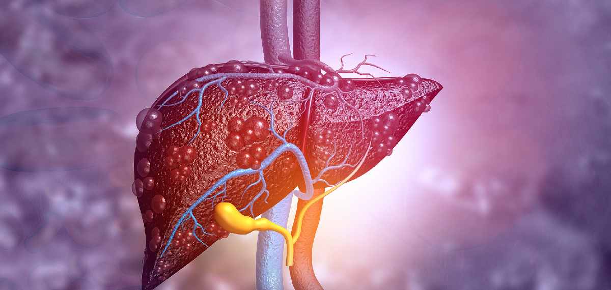fatty liver