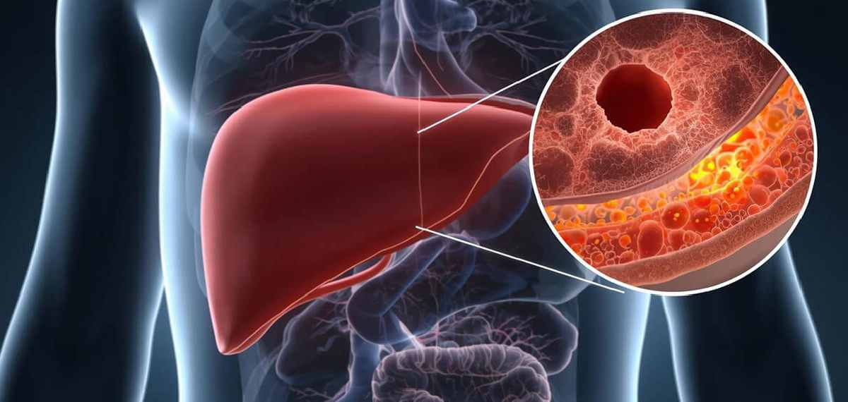 fatty liver