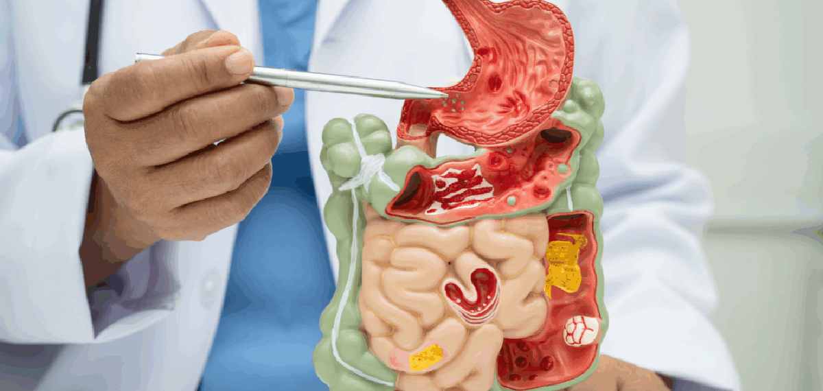 fatty liver