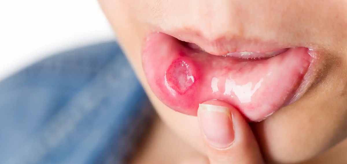 mouth cancer