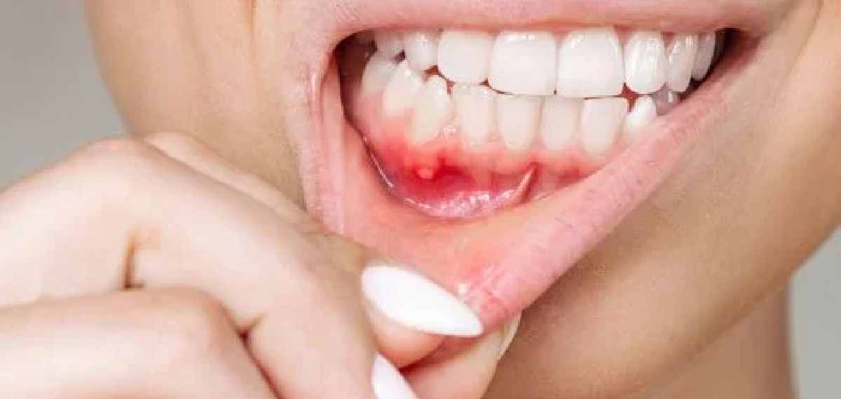 mouth cancer