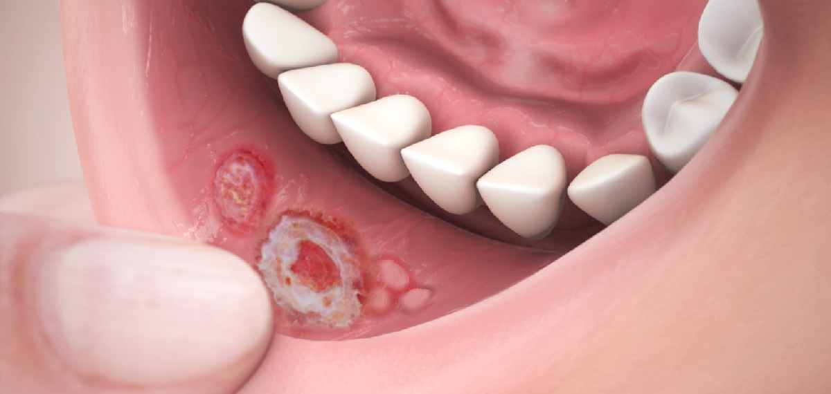 mouth cancer
