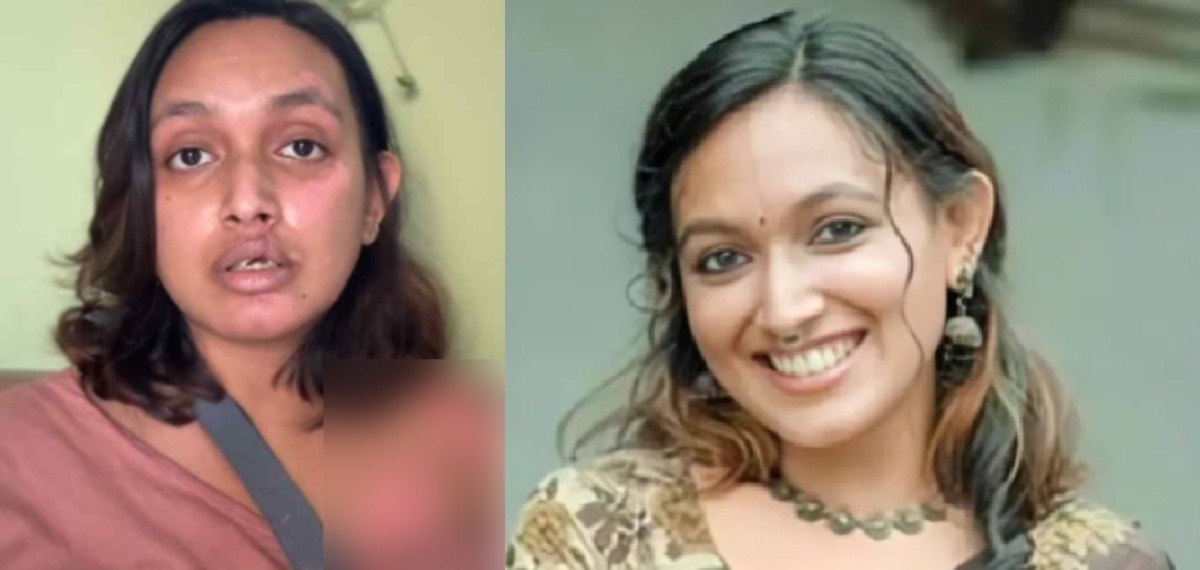 അപകടം നടന്ന് രണ്ട് മാസം; സാനി കൃഷ്ണയെ തിരിഞ്ഞ് നോക്കാതെ റാപിഡോ