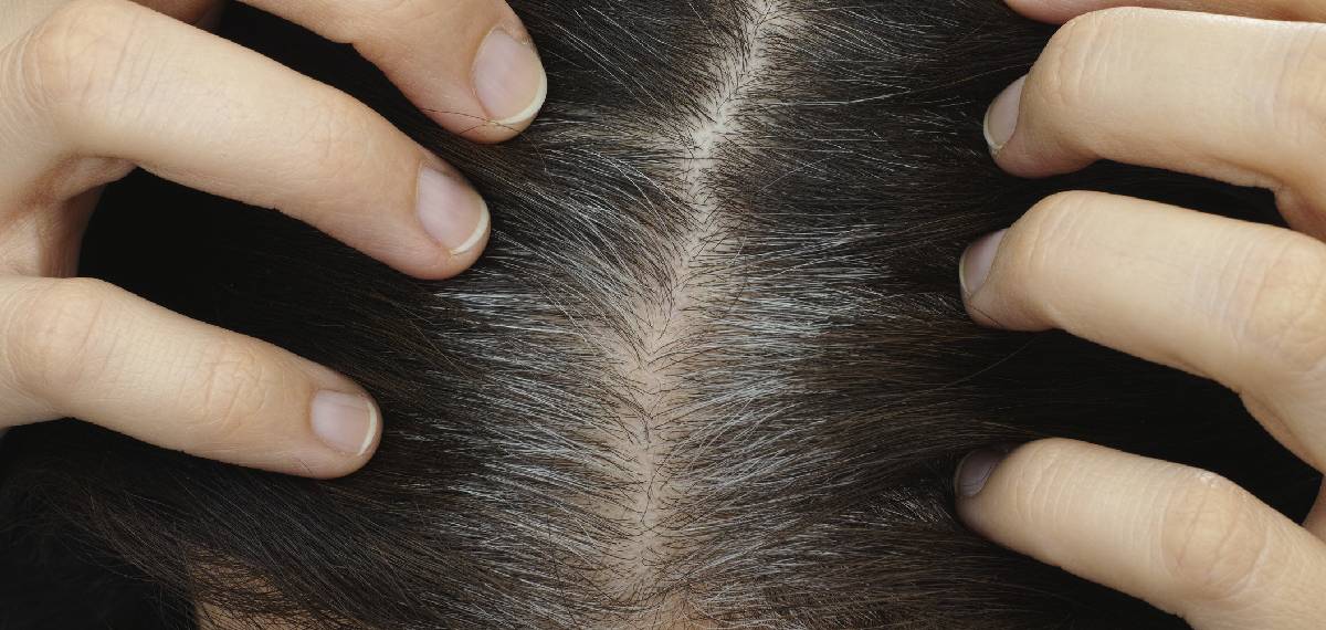 hair turning grey before the age of 35