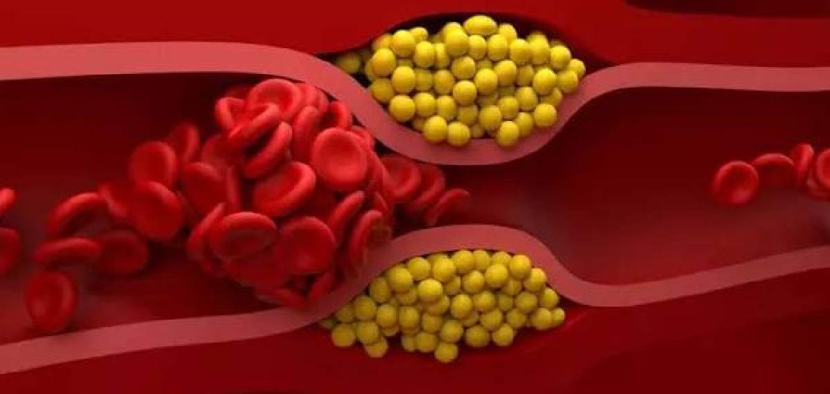 low HDL cholesterol