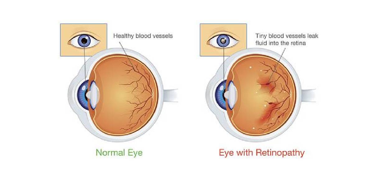 diabetic retinopathy