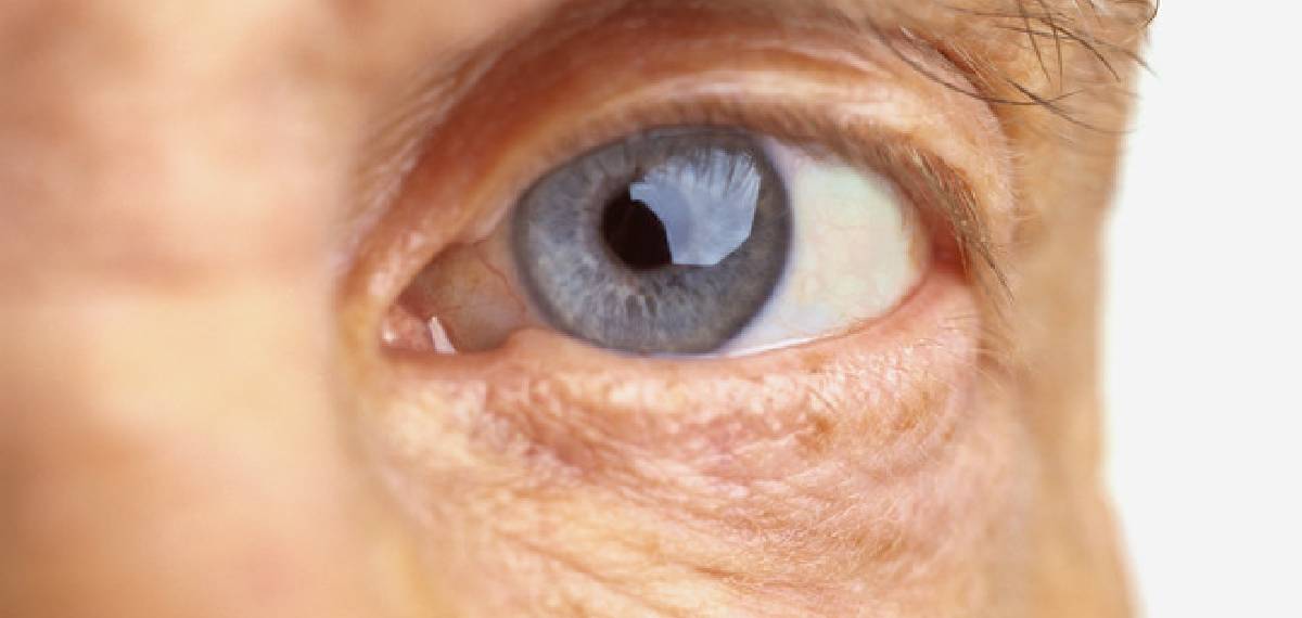 diabetic retinopathy