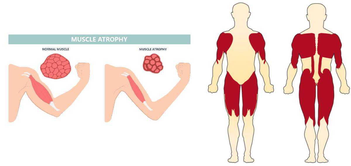SMA (Spinal Muscular Atrophy)