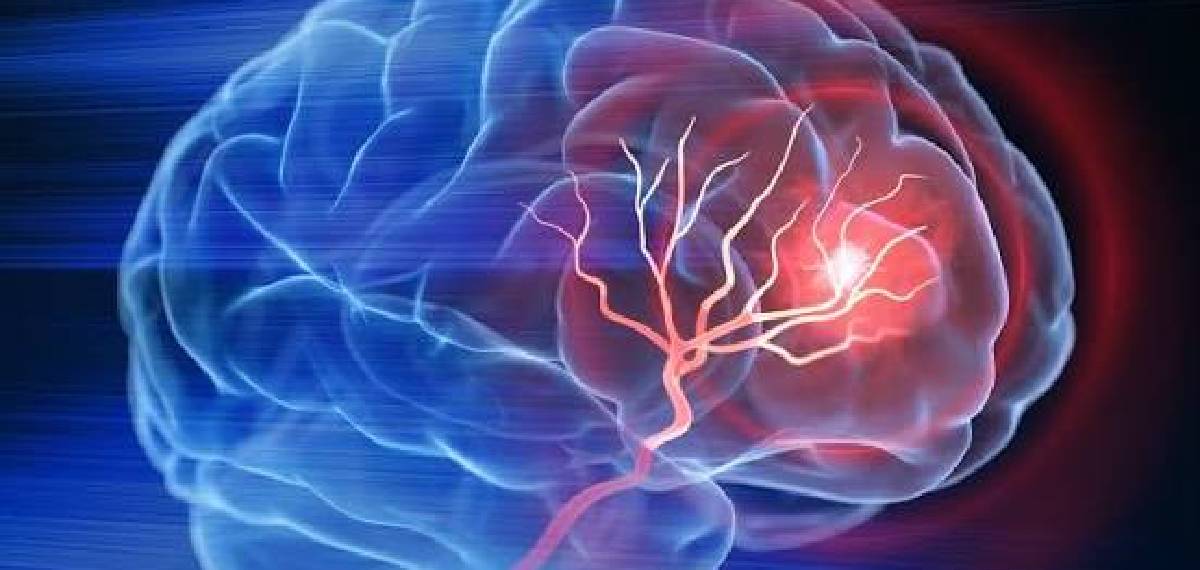 Transient Ischemic Attack 