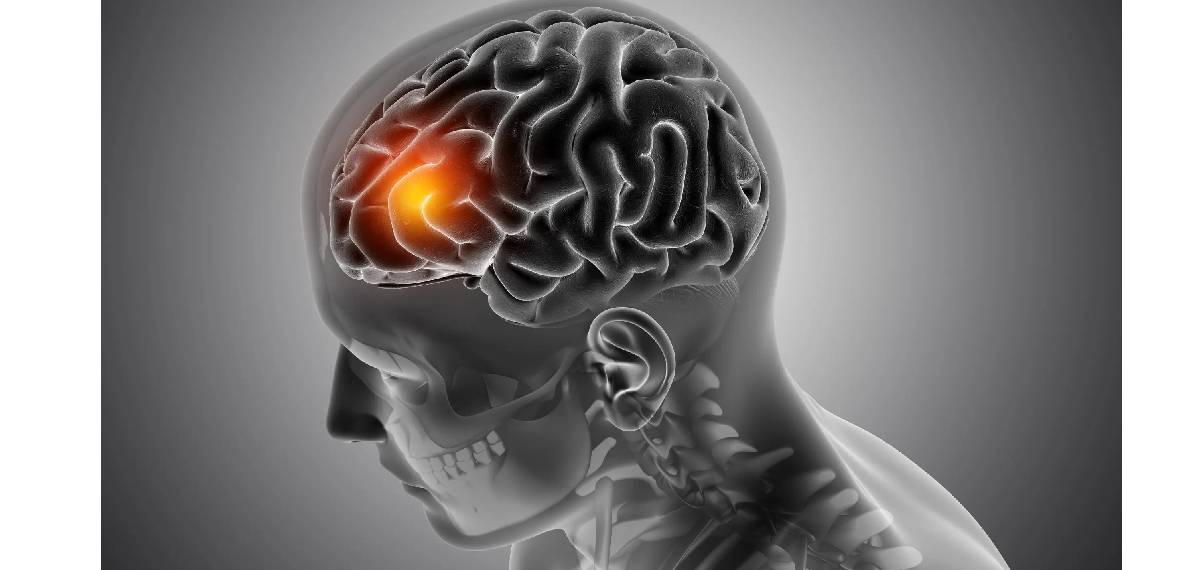 Transient Ischemic Attack 
