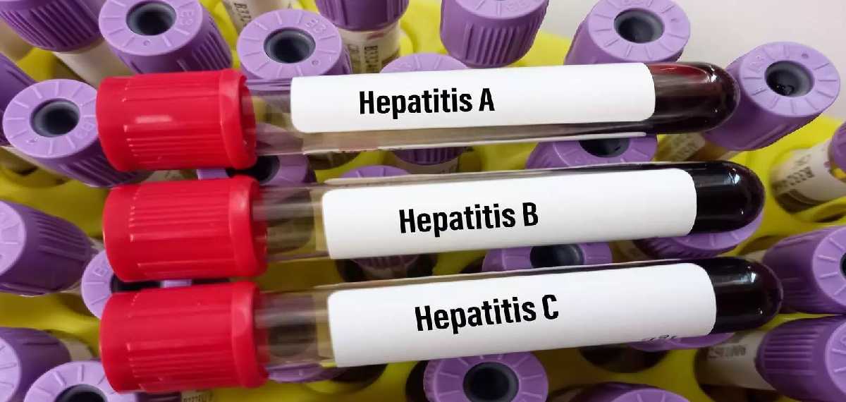 hepatitis