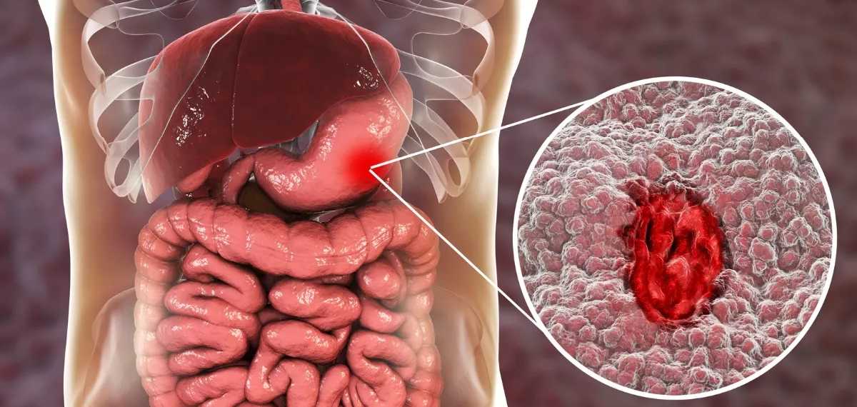 gastrointestinal stromal tumors, or GISTs