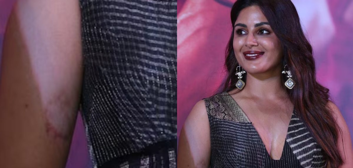 ഫൈറ്റ് ഷൂട്ടിൽ പറ്റിയ അപകടമോ ? സംയുക്തയുടെ കയ്യിൽ ഇത് എന്ത് പറ്റിയെന്ന് ആരാധകർ